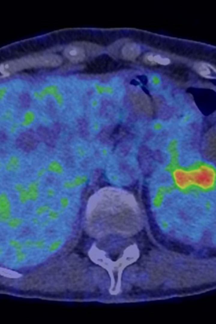 Scan des Bauchraums, der Krebs ist rot eingefärbt