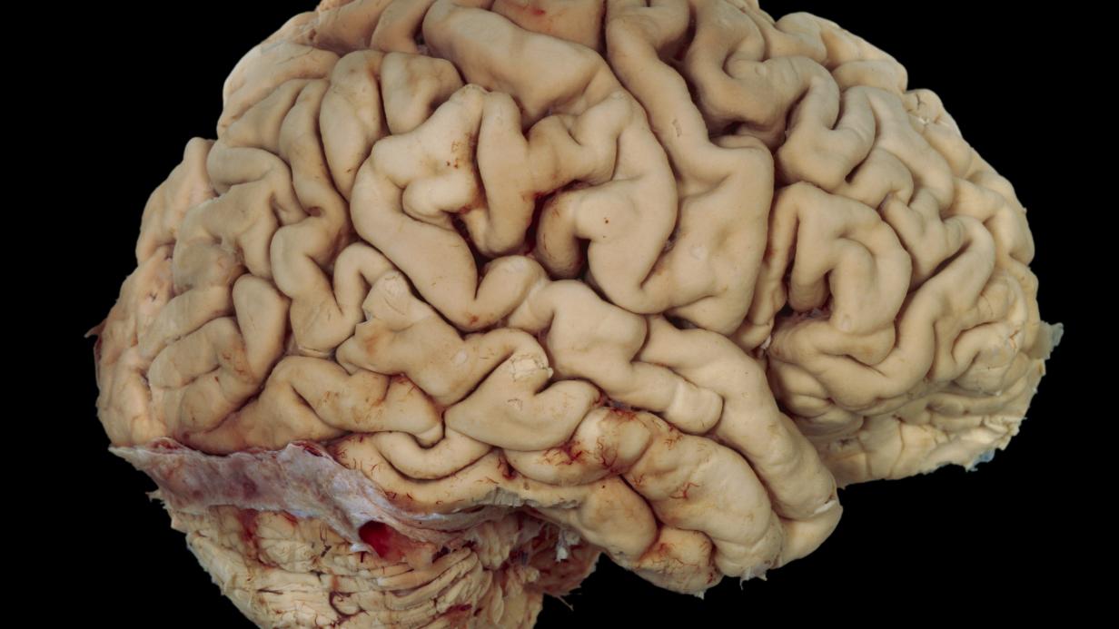 Neuroforschung Ein Fehler Stellt Tausende Gehirnstudien Infrage Profil At