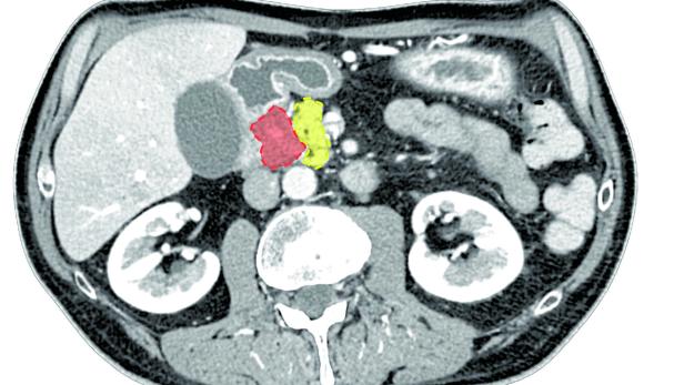 Das Bild aus dem sogenannten Photon-Counting-Computertomografen, der seit einem Jahr am AKH Wien steht, ermöglicht eine präzise Diagnostik. Rot markiert ist das Pankreaskarzinom, gelb die Bauchspeicheldrüse.