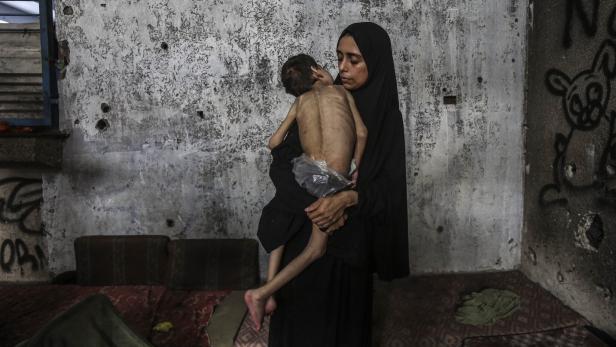 Two Palestinian brothers suffer from malnutrition amid Israeli attacks on Gaza
