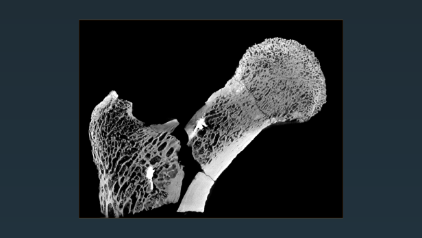 CT-Scan eines Millionen Jahre alten Oberschenkelknochens