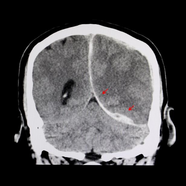 CT-Aufnahme des Gehirns eines Patienten mit Gehirnblutung (Symboldild)