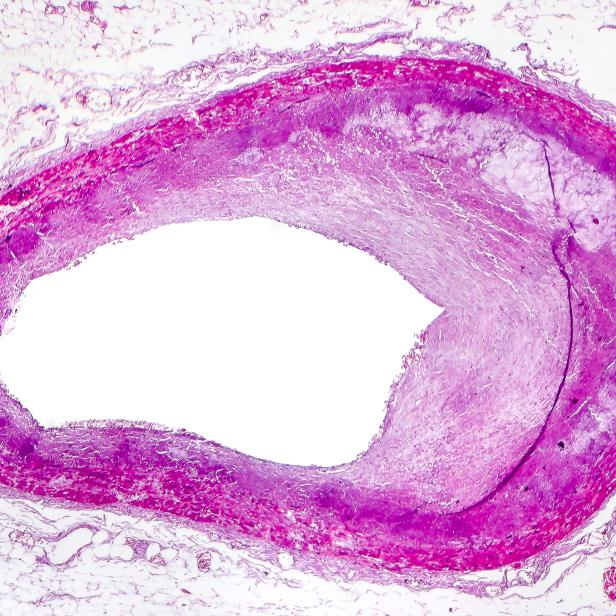 Koronare Atherosklerose, Lichtmikrograph mit cholesterinhaltiger Plaque in der Herzkoronararterie, Foto unter Mikroskop