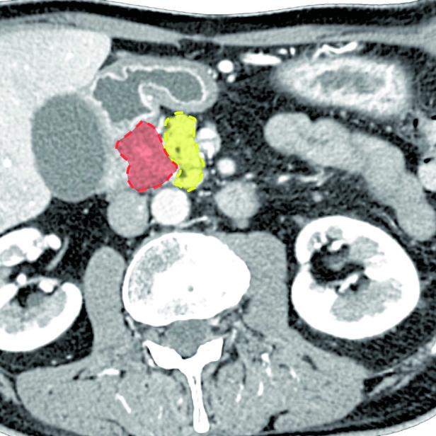 Das Bild aus dem sogenannten Photon-Counting-Computertomografen, der seit einem Jahr am AKH Wien steht, ermöglicht eine präzise Diagnostik. Rot markiert ist das Pankreaskarzinom, gelb die Bauchspeicheldrüse.