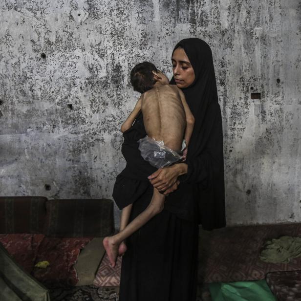 Two Palestinian brothers suffer from malnutrition amid Israeli attacks on Gaza