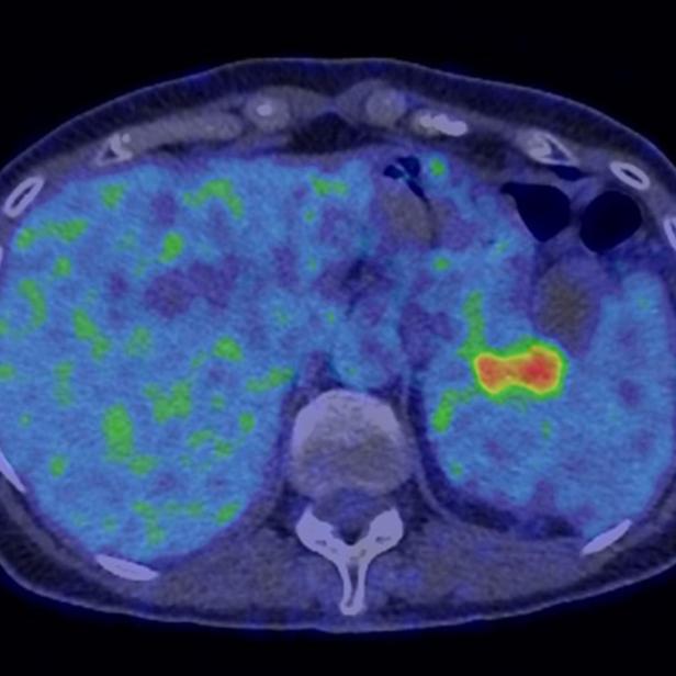 Scan des Bauchraums, der Krebs ist rot eingefärbt
