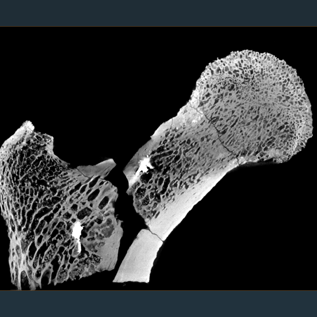CT-Scan eines Millionen Jahre alten Oberschenkelknochens