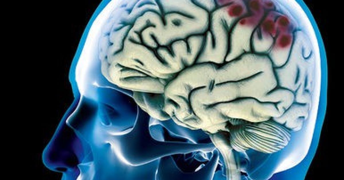 Brain 2024. Кровоизлияние в мозг фото. Кровоизлияние в мозг фото человека.